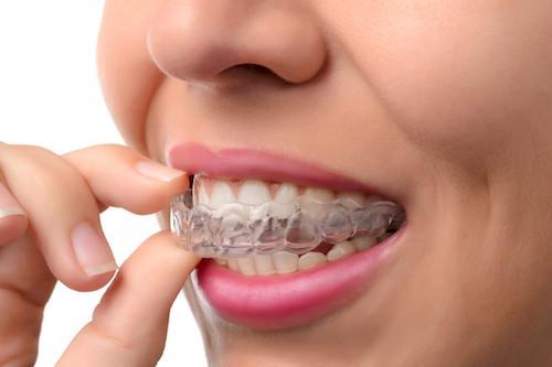 Patient placing clear aligners on her teeth in Jonesboro, AR