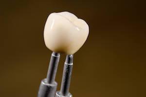 a single dental crown being help up by a dental instrument