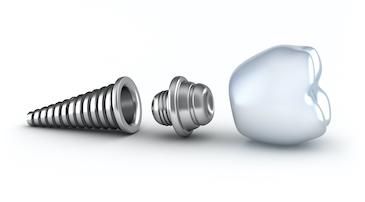 Illustration of a dental implant in Dental Solutions