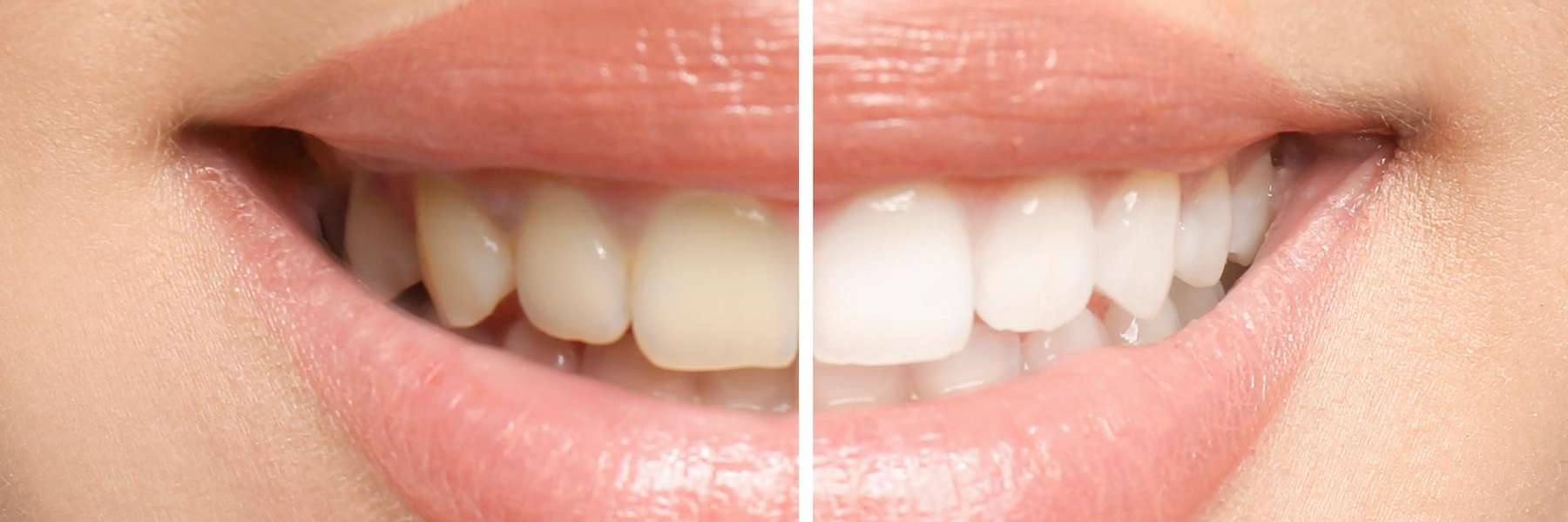Patient's teeth after professional whitening at Dental Solutions