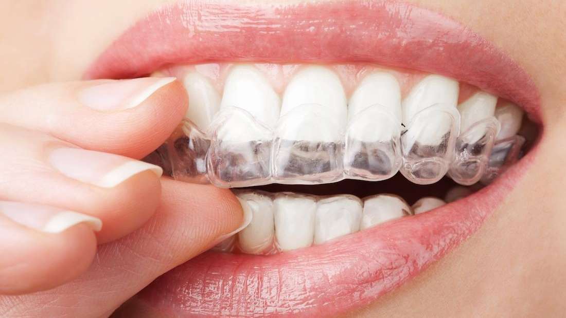Invisalign vs. Braces Which Is Better? Invisalign Jonesboro AR