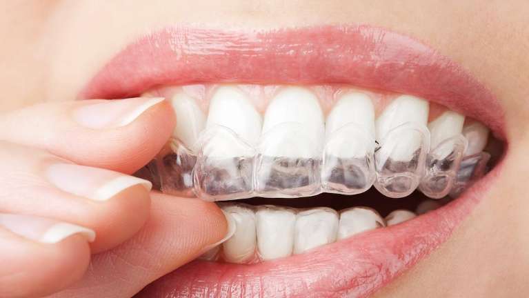 Patient placing clear aligners on her teeth