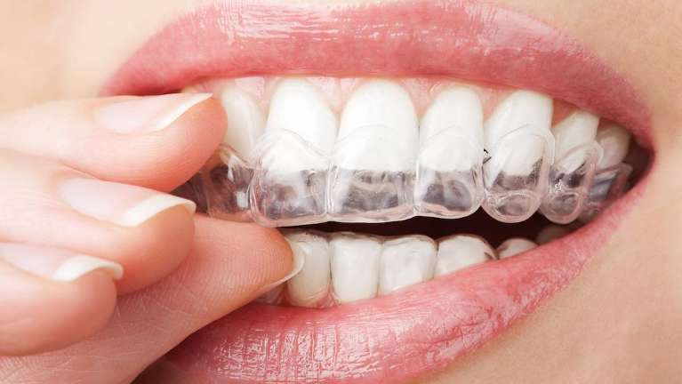 Patient placing clear aligners on her teeth in Jonesboro, AR
