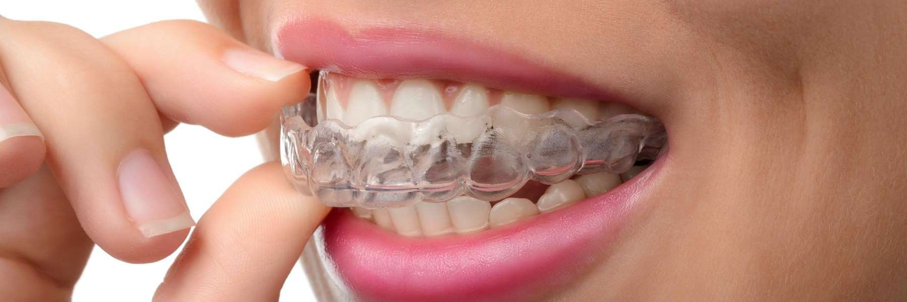 Patient placing aligners on her teeth in Jonesboro, AR