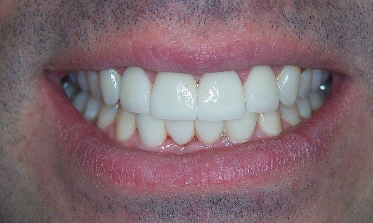 Smile-Makeovers-With-Crowns-More-After-Image