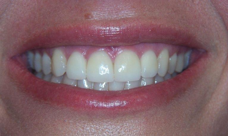 Invisalign-Success-Story-After-Image