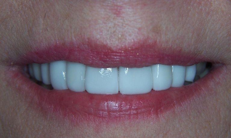 Veneers-Dental-Crowns-Teeth-Whitening-After-Image
