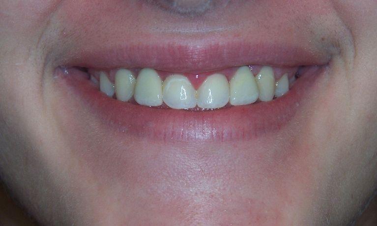 Replace-missing-teeth-permanently-with-dental-implants-After-Image