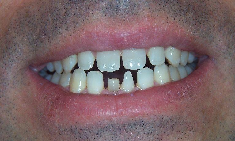 Smile-Makeovers-With-Crowns-More-Before-Image