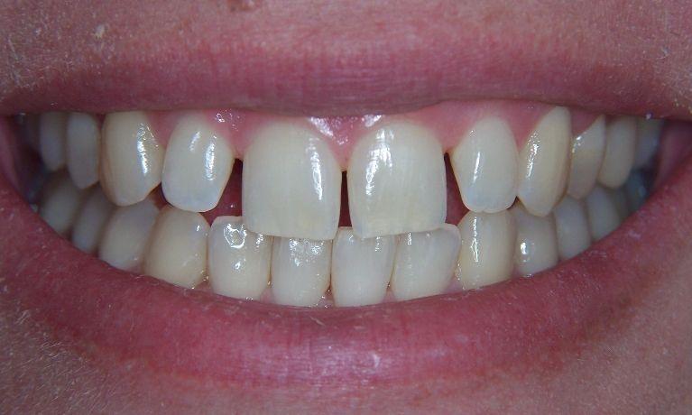 Invisalign-Success-Story-Before-Image