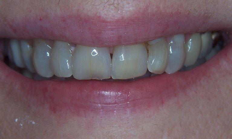 Veneers-Dental-Crowns-Teeth-Whitening-Before-Image