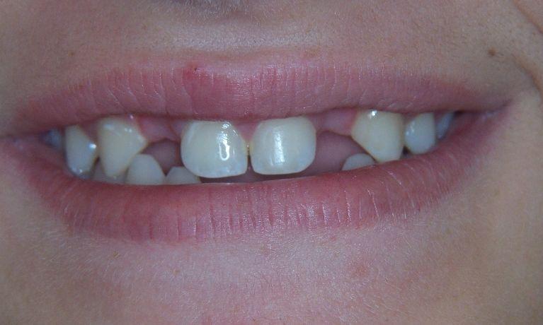 Replace-missing-teeth-permanently-with-dental-implants-Before-Image